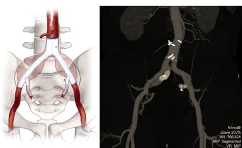 Total Robotic Iliac Aneurysm Repair With Preservation Of The Internal Iliac Artery Using