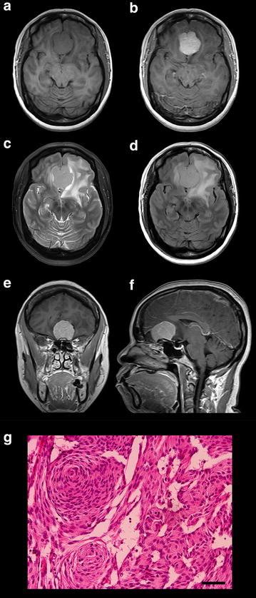 Neuroimaging And Histopathological Findings Of Original KCI MENG1