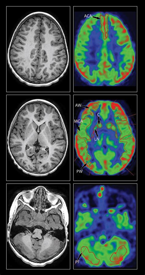 Regions Of Interest On The Arterial Spin Labeling Sequence Left