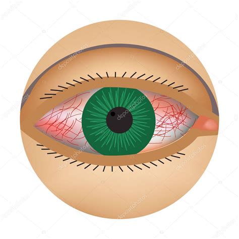 Enrojecimiento De Los Ojos S Ntoma De Conjuntivitis Alergias