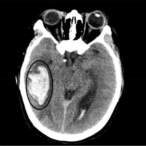 Ct Scan Of Cerebral Hemorrhage Download Scientific Diagram