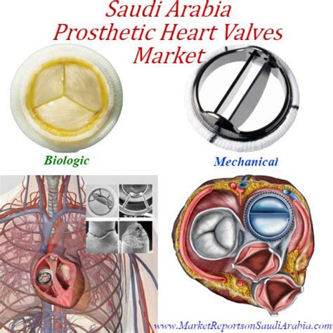 Prosthetic Heart Valve