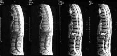 Chronic Osteomyelitis Imaging Practice Essentials Radiography