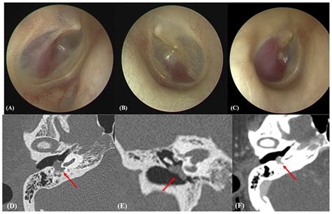 Glomus Tumor Hot Sex Picture