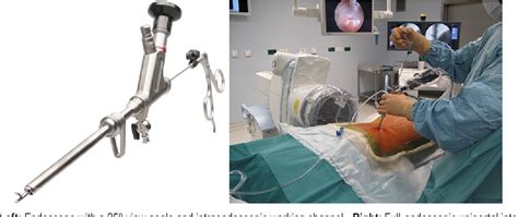 Figure 1 From Full Endoscopic Uniportal Decompression In Disc