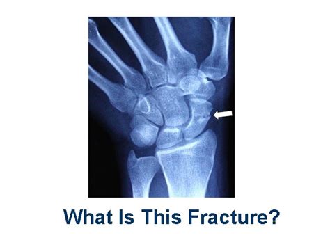 Splinting Immobilization Learning Objectives Appropriate immobilization ...