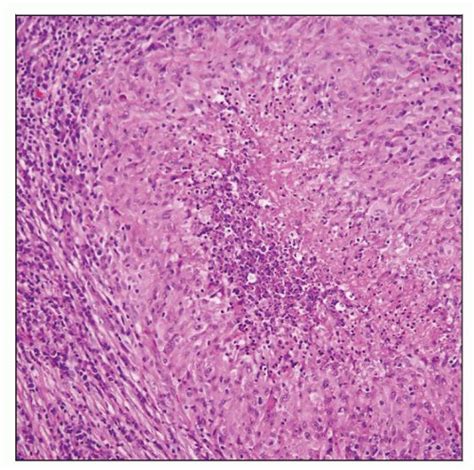 Chronic Granulomatous Lymphadenitis | Basicmedical Key