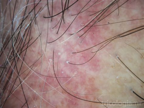 Alopecia Frontal Fibrosante Tricolog A Y Trasplante Capilar Mir