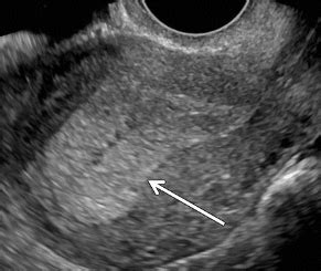 Thickened Uterine Lining seen on Ultrasound: What You Need to Know ...