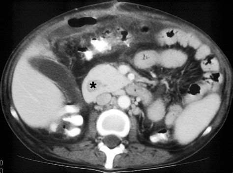 Pancreatic And Peripancreatic Diseases Mimicking Primary Pancreatic