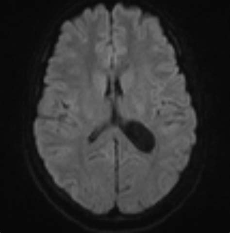 Intraventricular Simple Cyst Image