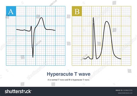 Hyperacute T Waves