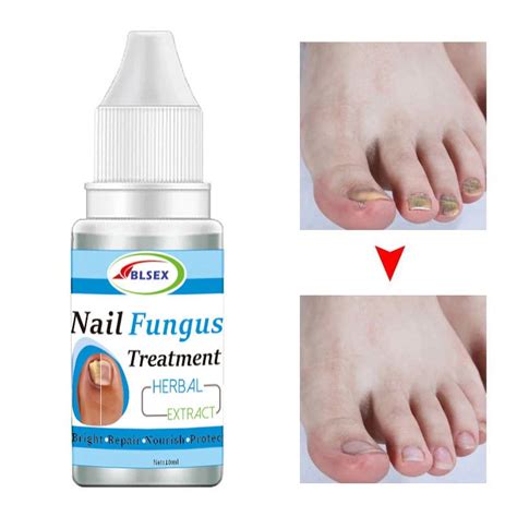 Chouxx 3 Pack Nail Repair Solution Toenail Fungus Solution Nail