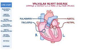 Pulsus parvus et tardus: What Is It, Causes, and More | Osmosis