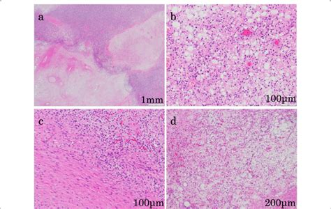 Microscopic Findings Of The Tumor Hematoxylin And Eosin Staining A