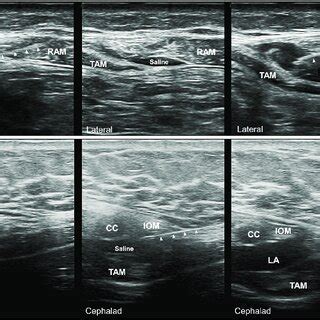 Ultrasound Images Of Subcostal Transversus Abdominis Plane Block A