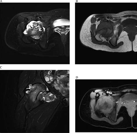 Multiple Series Of Coronal T2 Fat Saturated Axial T1 T2