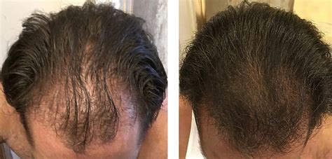 Finasteride Results: Timeline, Photos, Before & After