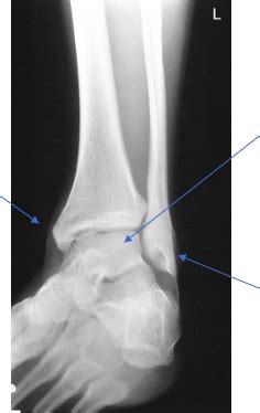 Oblique Ankle Diagram Quizlet