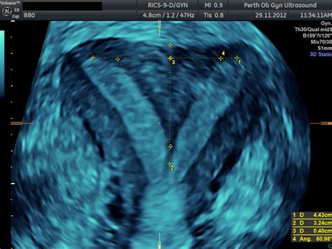 Pelvic Ultrasound - POGU