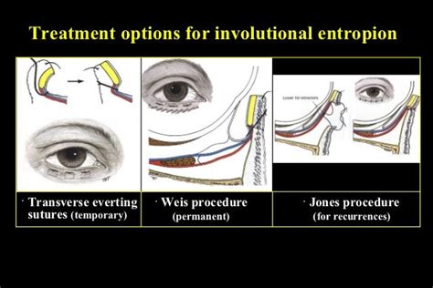 Ectropion And Entropion