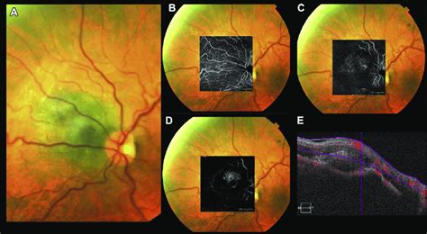 Juxtapapillary Congenital Hypertrophy Of Retinal Pigment Epithelium