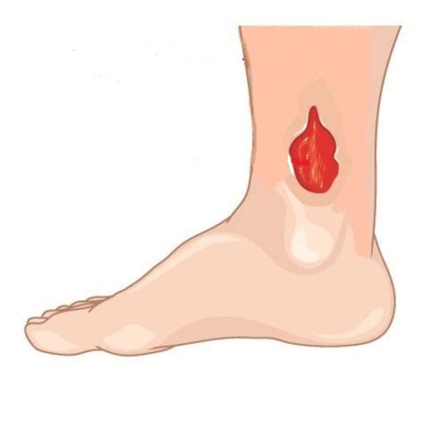 Leg Ulcers - Dr. Hristo Boytchev-Cape Vascular Clinic