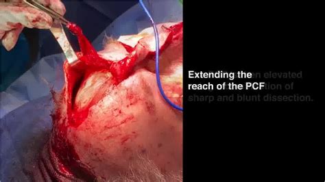 Reconstruction Of Large Composite Nasal Defects When Pedicled Septal