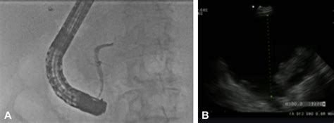 A Ercp Demonstrating A Cut Off Pancreatic Duct Consistent With Central Download Scientific