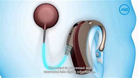 How A Cochlear Implant Works By Advanced Bionics Youtube