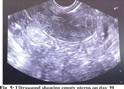 Figure 2 From A Success Of Cesarean Scar Ectopic Pregnancy By