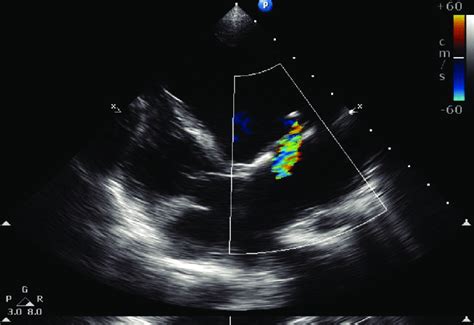 Postoperative Apical Four Chamber Transthoracic Echocardiography After