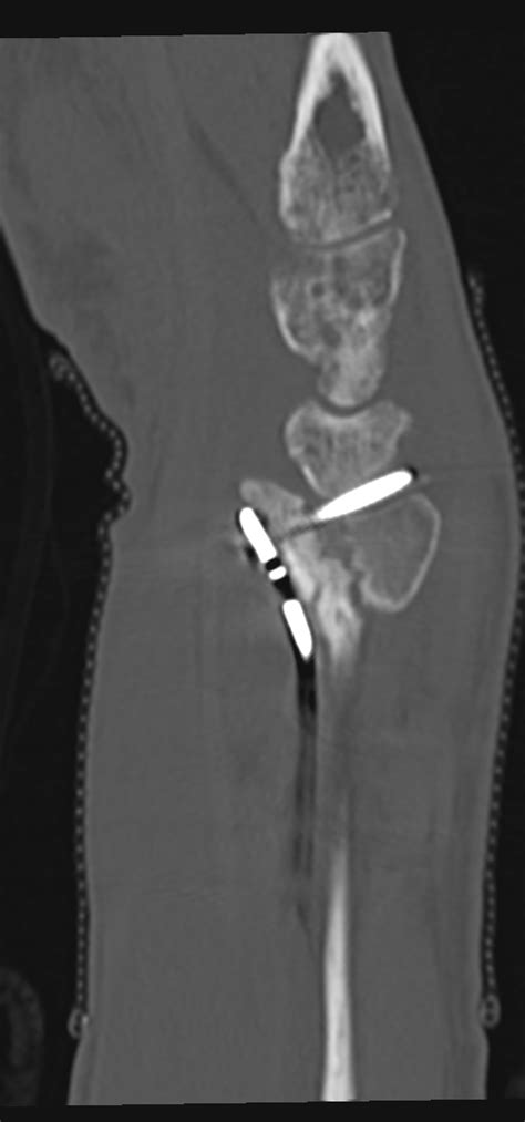 Volar Locking Plate Fixation Screw Malposition Image Radiopaedia Org