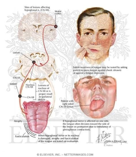 Hypoglossal Nerve CN XII