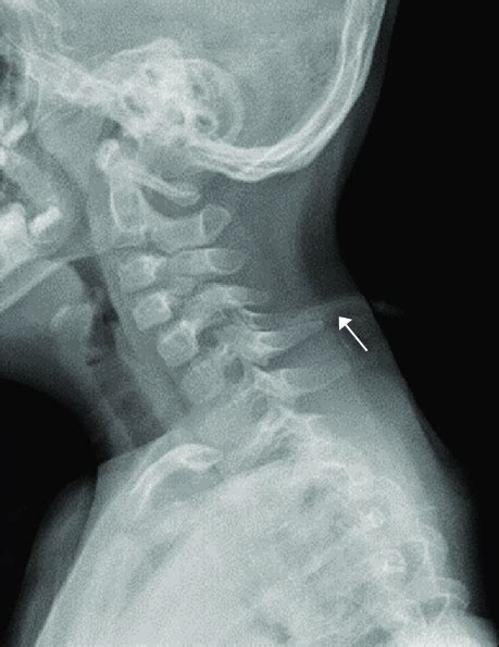 Cervical Plain Radiographs Showed Abnormal Tubular Structures In