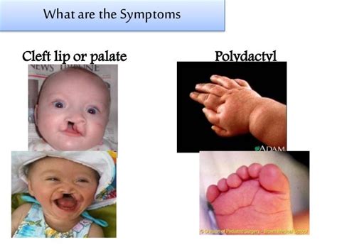 Patau Syndrome