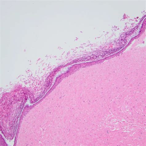 Higher Magnification Photomicrograph Demonstrating Fibrotic Cyst Wall