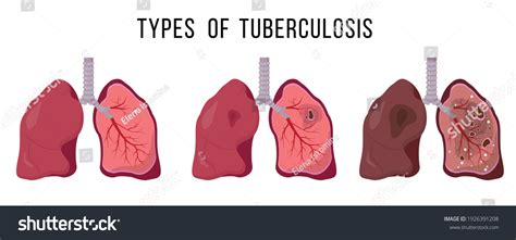 Human Lungs Infected Mycobacterium Tuberculosis Latent Stock Vector