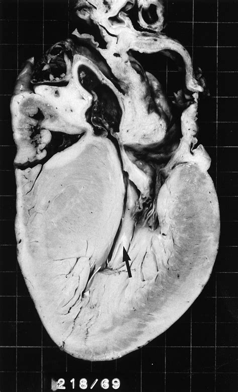 Hypertrophic Cardiomyopathy Circulation