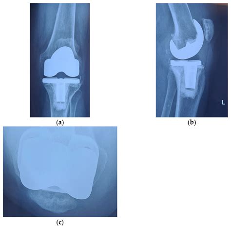 Diagnostics Free Full Text Patellar Resurfacing In Total Knee