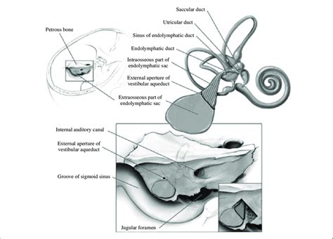 Endolymphatic Sac And The Surrounding Perisaccular Tissues Is The Main Download Scientific