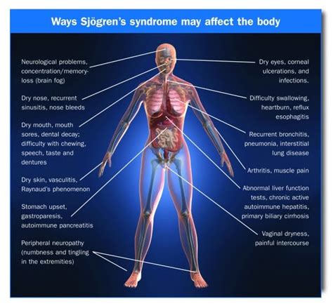 Sjogren's Syndrome Diet Chart