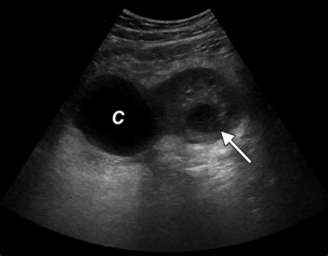 Adnexal torsion in a 13-year-old girl with a right adnexal simple cyst... | Download Scientific ...