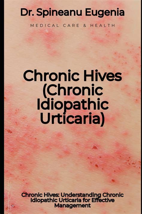 Chronic Hives Understanding Chronic Idiopathic Urticaria For Effective