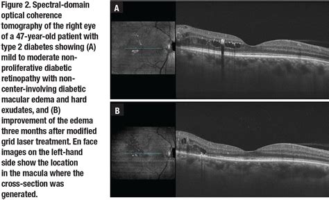 Macular Edema Oct