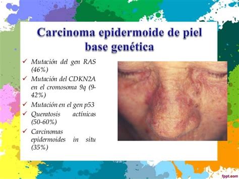 Cancer Escamoso Y Basocelular De Piel 2