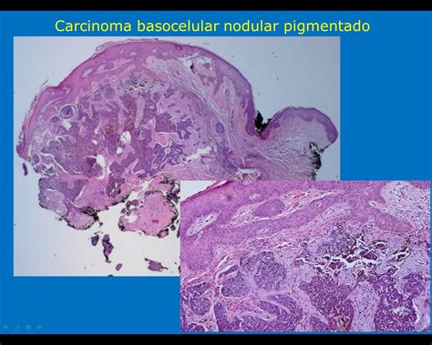 Dermatopatologia Carcinoma Basocelular