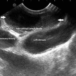 Endoscopic Ultrasound Eus Enlarged Hypoechoic Subcarinal Lymph Node