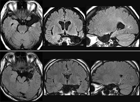 Postoperative Magnetic Resonance Imaging Showing The Extent Of