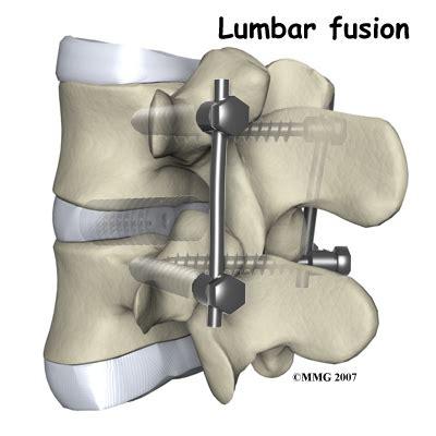 Physical Therapy In Cincinnati And West Chester For Back Lumbar Disc